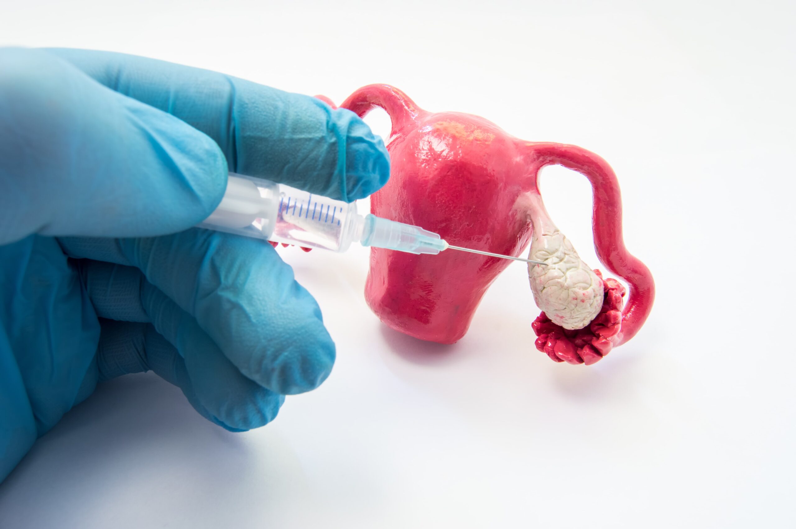 Endometriosis IVF Successes injection Visualisation